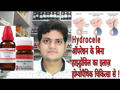 Hydrocele ! Homeopathic medicine for Hydrocele ? explain !