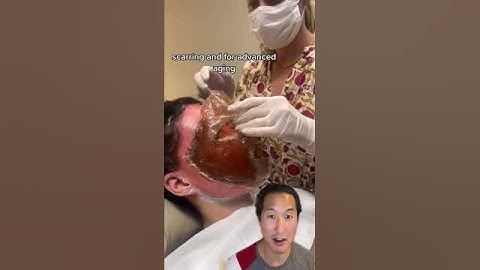 Watch Her Skin Get Lifted Off Her Face! #phenol #chemicalpeel