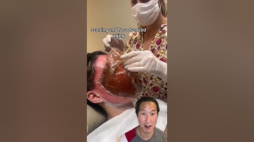Watch Her Skin Get Lifted Off Her Face! #phenol #chemicalpeel