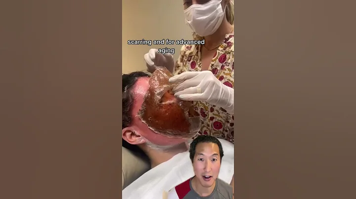 Watch Her Skin Get Lifted Off Her Face! #phenol #chemicalpeel - DayDayNews