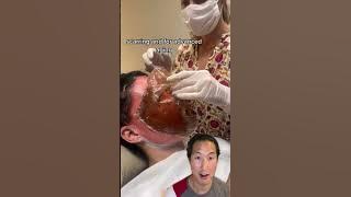 Watch Her Skin Get Lifted Off Her Face! #phenol #chemicalpeel
