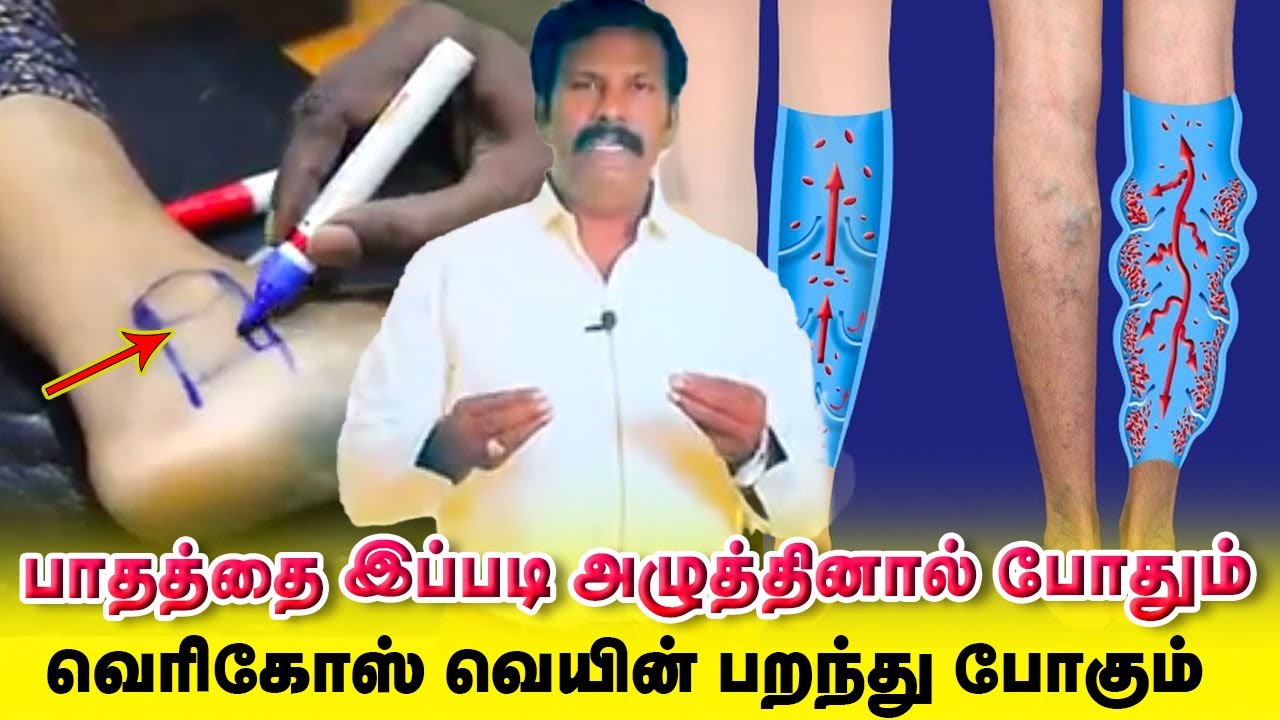 Sciatica pain - Varicose vein | பாதத்தை இப்படி அழுத்தினால் பறந்து போகும் |  Yogam | யோகம்