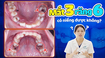 Mất 3 Răng 6 Có Niềng Được Không? Tiết Kiệm Ít Nhất 30 Triệu Nếu Theo Phác Đồ Này Của Bác Sĩ