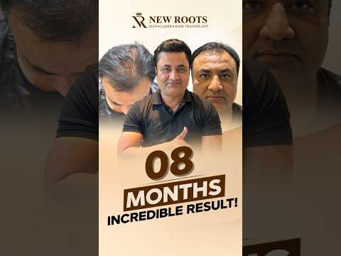 Grade 4 Baldness Hair Transplant in Aurangabad | Chhatrapati Sambhajinagar #hairtransplant #shorts