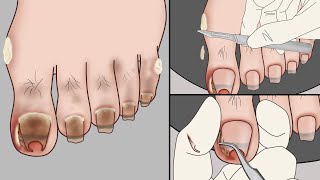 ASMR Ingrown Toenail Removal Treatment Animation~Strong Satisfaction!  | Meng's Stop Motion screenshot 2