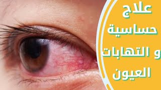 علاج حساسيه العين | التهاب الملتحمه الفيروسي| التهاب الملتحمه البكتيري | الحلقه 15 من كورس OTC