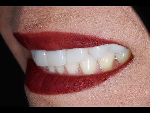 Video Procedure of Placing Dental Veneers with Dental Implant at Cosmetic Dental