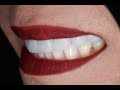 Procedure of placing dental veneers with dental implant at cosmetic dental associates