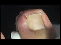 How to keep away from ingrown nail