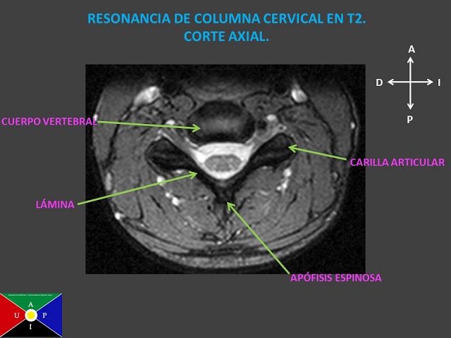 Anatomía De La Columna Cervical Por Resonancia Magnética