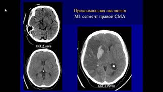 Костеников А.Н.«Неотложная КТ, МРТ, ЦАГ ишемического инсульта в условиях сосудистого центра»