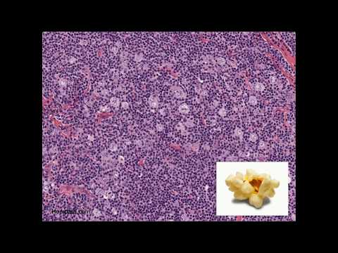 Histopathology - Nodular Lymphocyte Predominant Hodgkin Lymphoma