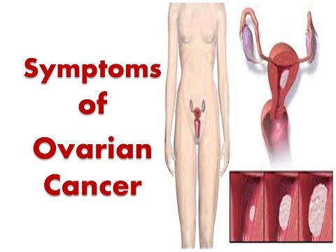 Ovarian cancer signs and symptoms