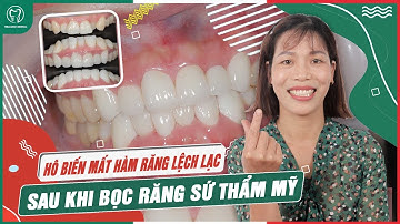 HÔ BIẾN MẤT HÀM RĂNG LỆCH LẠC SAU KHI BỌC RĂNG SỨ | Răng sứ thẩm mỹ tại Nha Khoa Italiano |