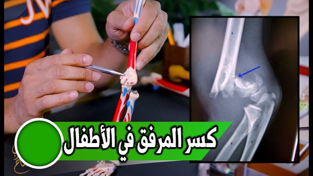 كسر المرفق فى الأطفال