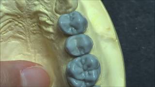Live wax up  Upper 2nd premolar(full)