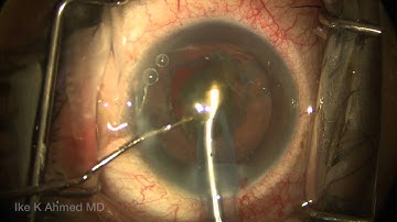 Cataract Surgery Routine: Phaco HemiFlip Ike Ahmed 1080pN