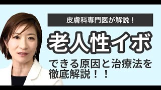 老人性イボ（脂漏性角化症）の取り方は？原因と予防方法について皮膚科専門医が解説