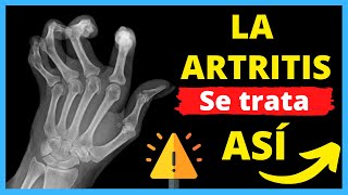 Los 7 Medicamentos para CURAR la ARTRITIS REUMATOIDE