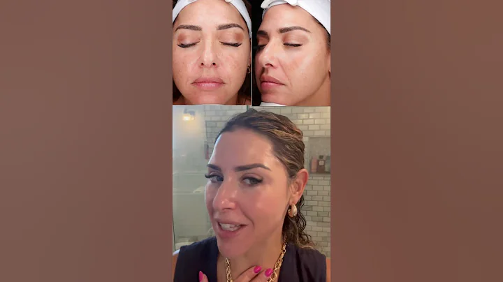 Melasma under control with ZO Skin Health #zoskinhealth