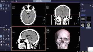 فحص الأشعة المقطعية على المخ بدون صبغة CT BRAIN screenshot 2