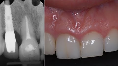 UNCUT! Immediate Tooth Replacement | Dr Sascha A Jovanovic | BLX Implant|Socket Xenog