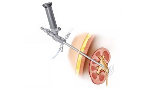 Удаление камней через прокол: что нужно знать про перкутанную литотрипсию