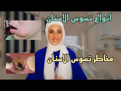 انواع تسوس الاسنان وطرق علاجه ما هى اسباب تسوس الاسنان وطرق علاجه