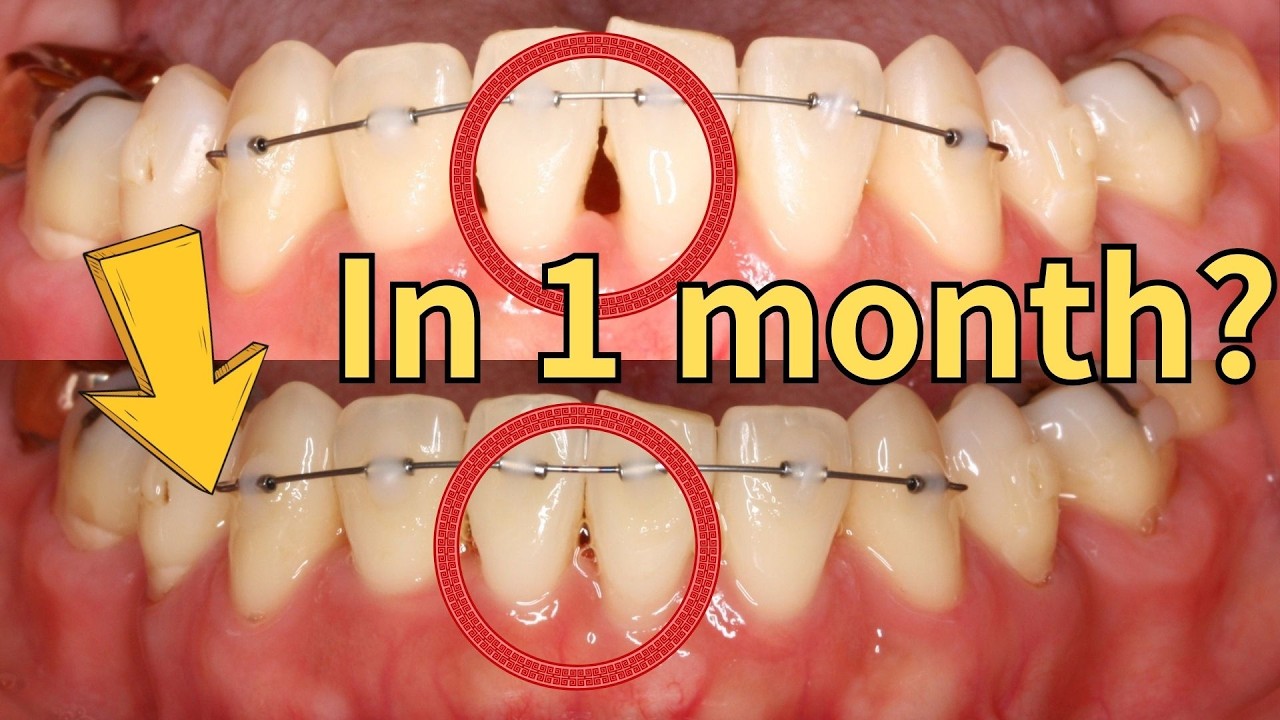 Reducing black triangle without interproximal reduction in 1 month
