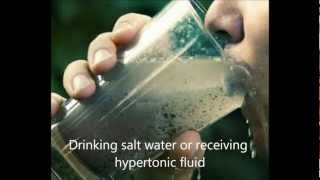 High Sodium, Hypernatremia, symptoms, treatment, management, cause, correction of hypernatremia