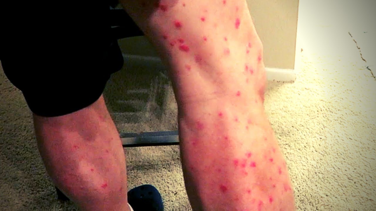 Cosentyx Rash One Year Without Cosentyx and my Psoriasis is BACK! - YouTube