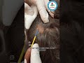 #scalpwart #wart #rfcautery #skindoctor