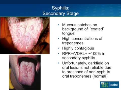 Video: Syfilis - årsager Og Symptomer På Syfilis