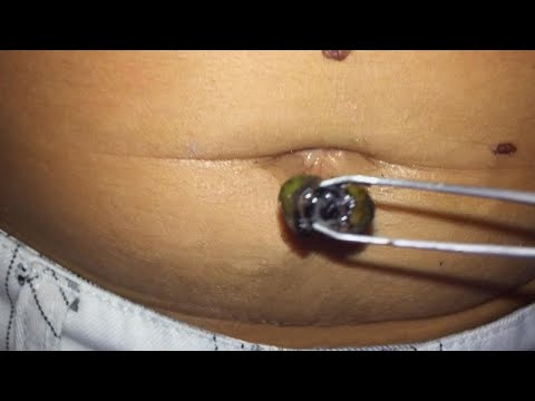 Navel Stones – What Are They and What Causes Them? - YouTube