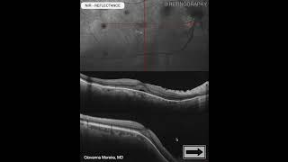 Dome-Shaped Macula Multimodal Imaging Analysis