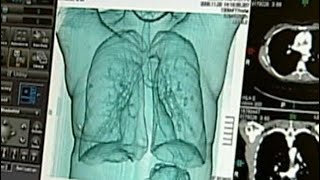 A look at new risk factors for lung cancer