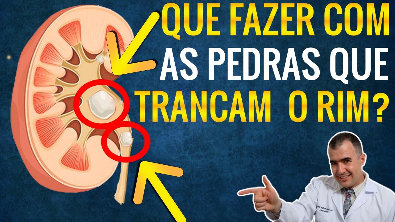 O que deve ser feito quando uma pedra tranca o RIM? - YouTube