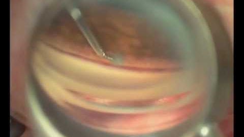 Istent - Real Time Surgery