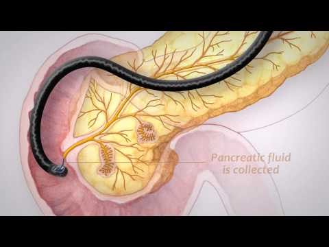 Pancreatic Cancer Screening