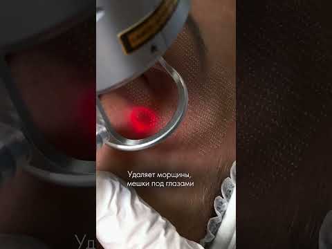 Лазерная БЛЕФАРОПЛАСТИКА #dermaxel