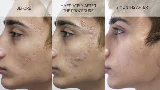 Acne scar subcision and filler