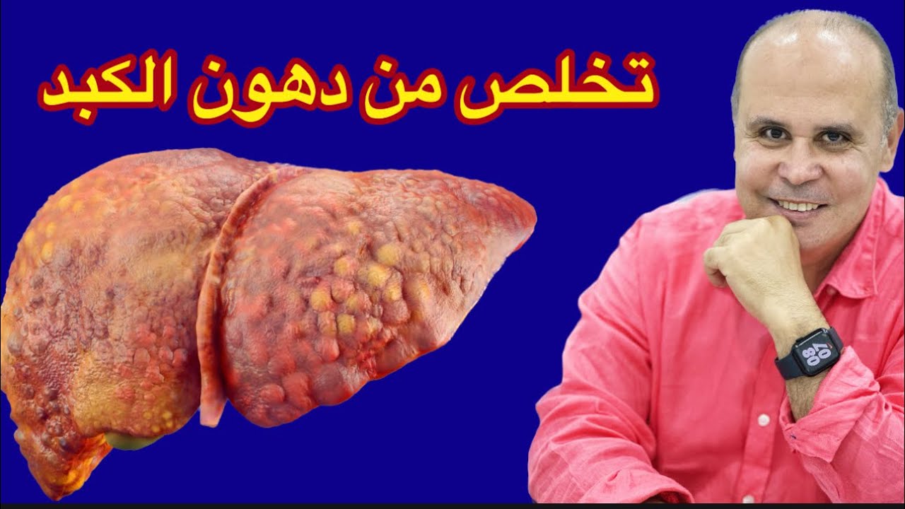 علاج مجاني لدهون الكبد في البيت في ٣٠يوم