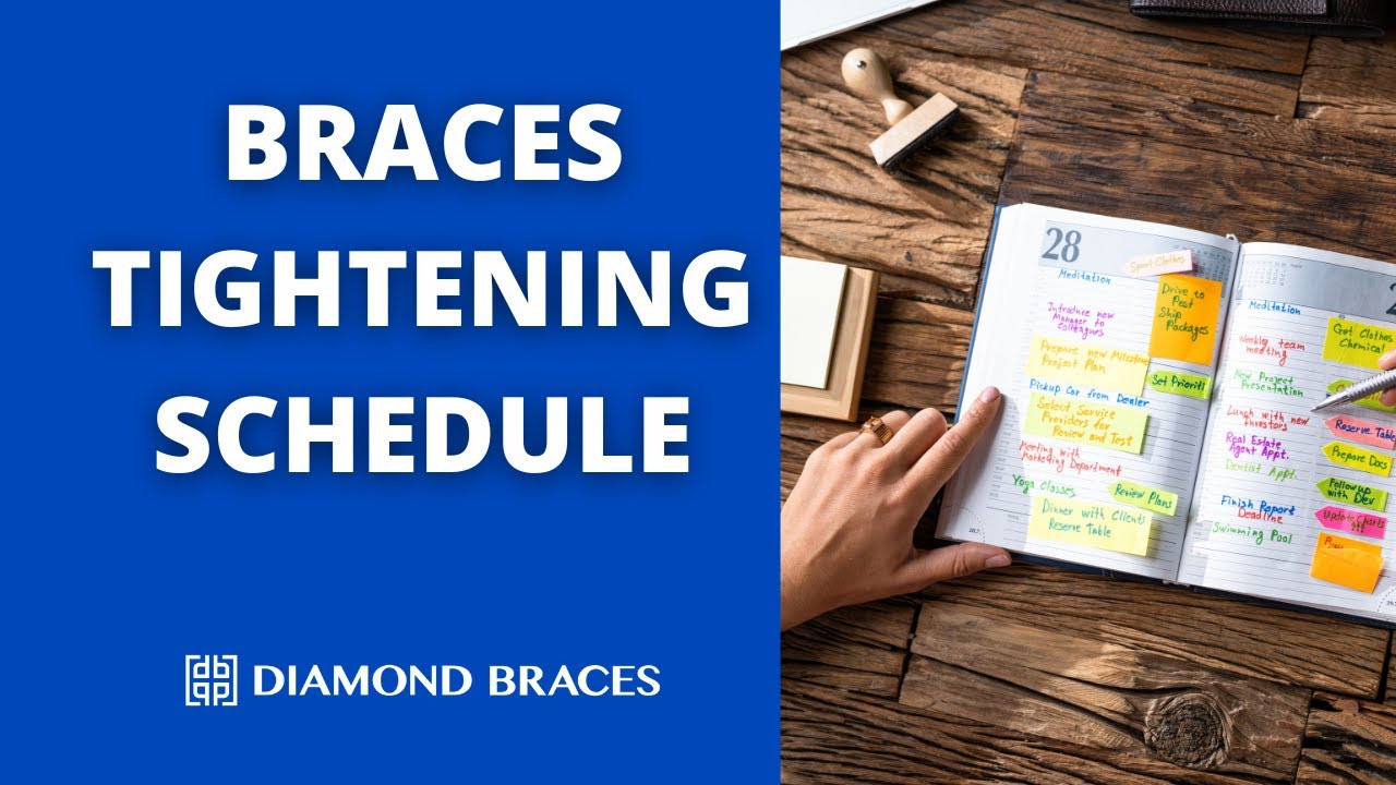 How Often Do I Need To Tighten My Braces? YouTube