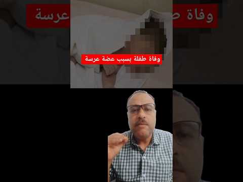 وفاة طفلة بسبب عضة عرسة