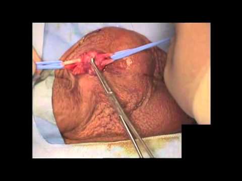 Single Incision Vasectomy Reversal - Dr Ethan Grober: Vasectomy Reversals Canada