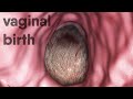 vaginal birth-natural childbirth