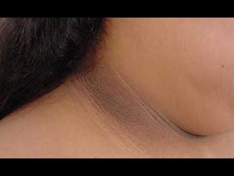 Hoe de huid in de hals lichter maken?
