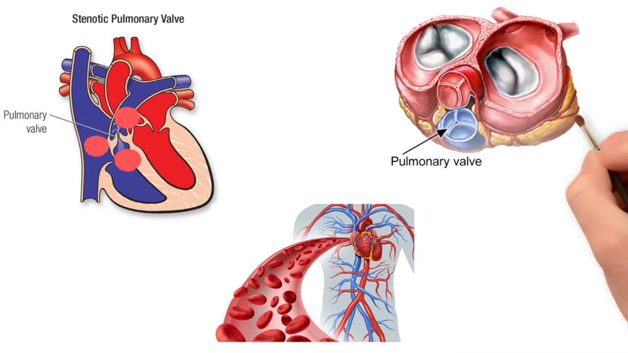 Pulmonary valve - YouTube