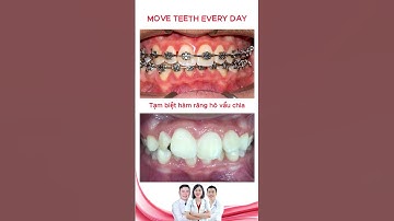 Niềng hàm răng hô vẩu chìa | Bác sĩ Thu Gia Lâm