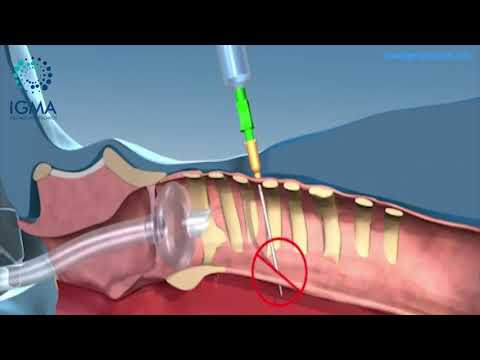 Video: ¿Cómo se realizan las traqueostomías?